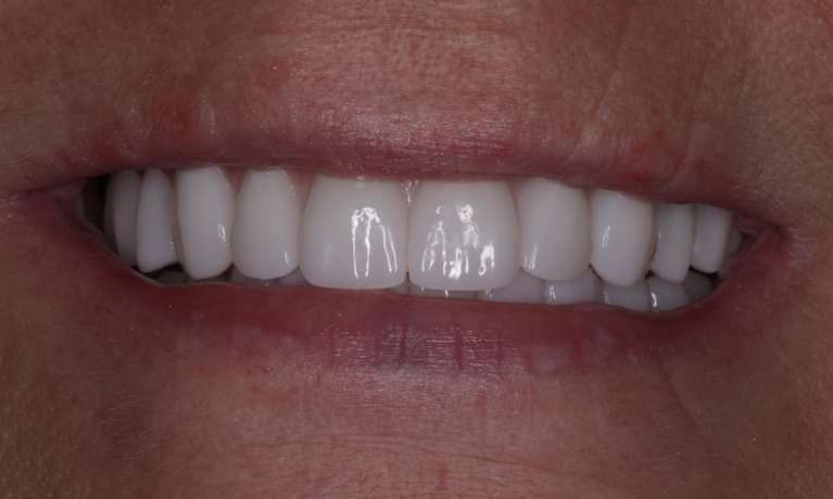 bright white smile after all on x dentures