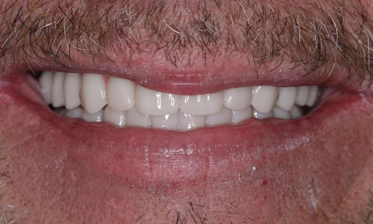 new bright smile after all on x dentures