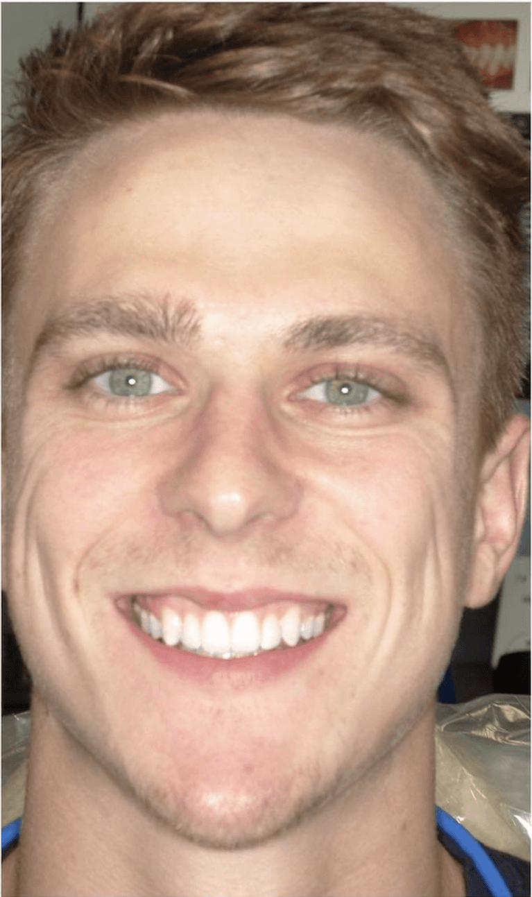 straight teeth after invisalign