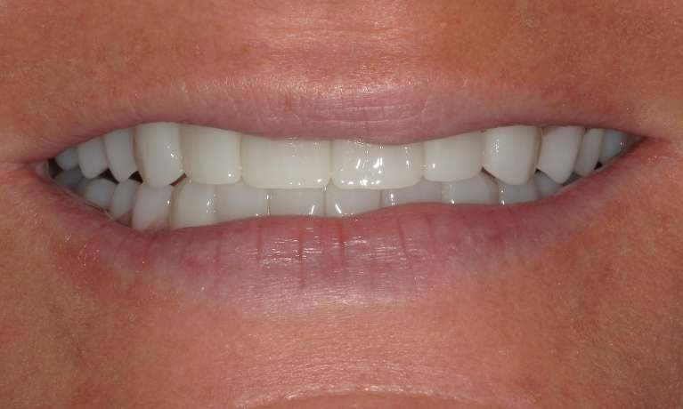 After Cosmetic Crowns