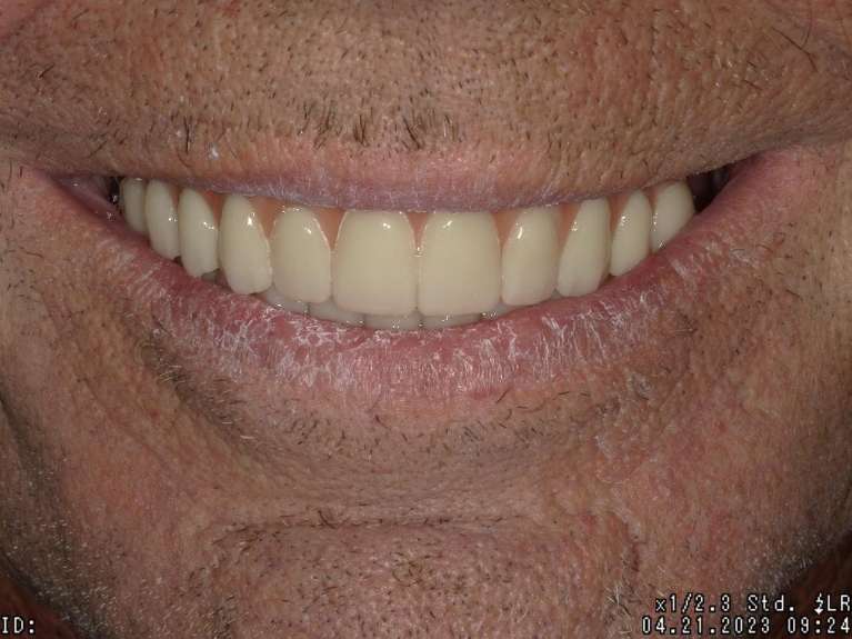 straight smile after upper and lower all on x implants
