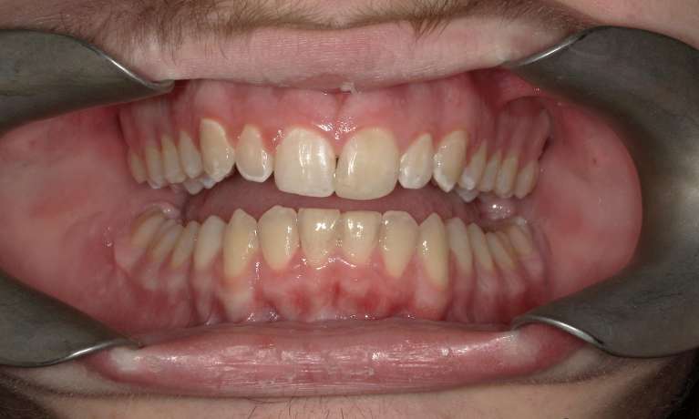 straight front teeth
