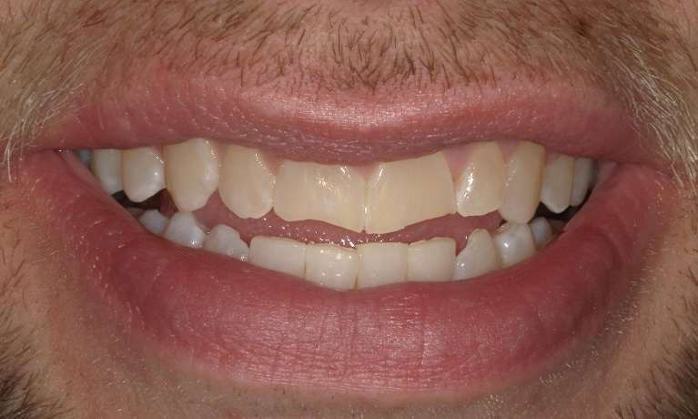 straight bottom teeth