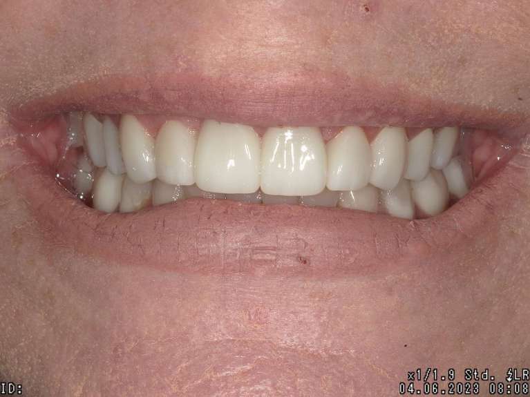 new smile after smile makeover