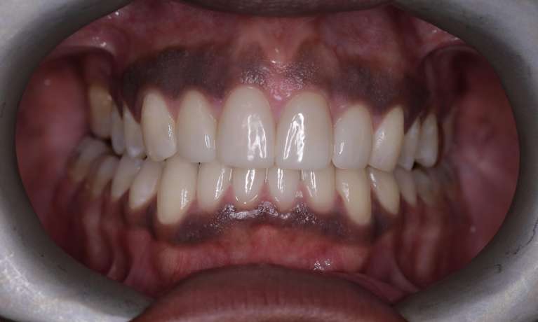 bright smile after whitening