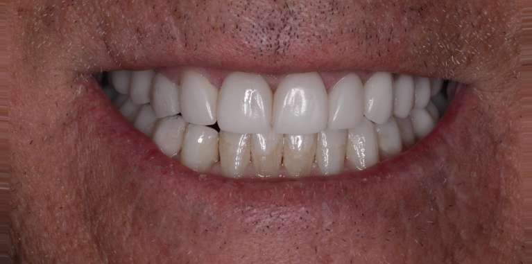 bright white teeth after smile makeover