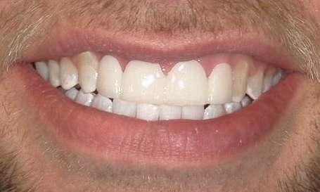 white teeth after smile makeover
