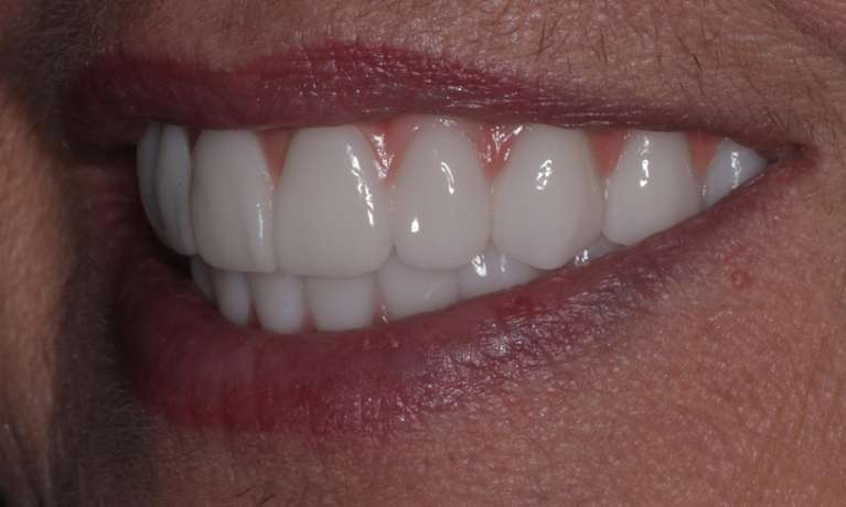 After All-on-X Implant-Supported Dentures in Evansville, IN