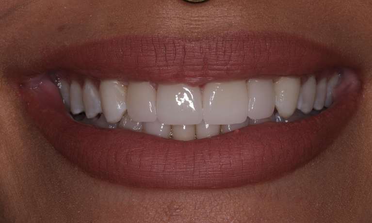 After Invisalign and Cosmetic Crowns in Evansville, IN