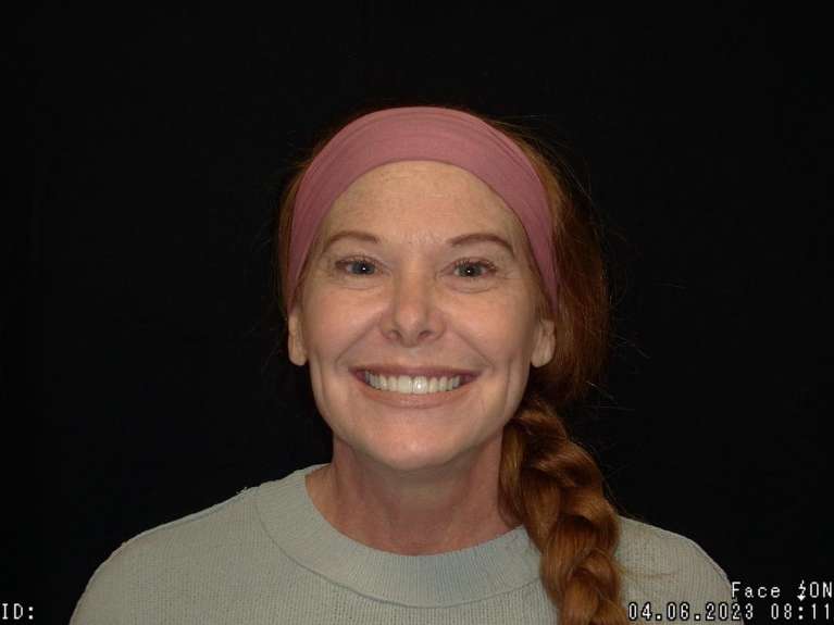 patient smiling after smile makeover