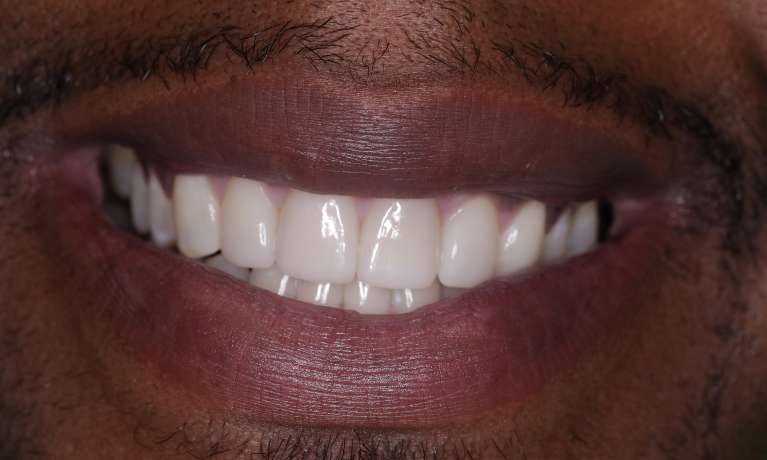bright smile after whitening