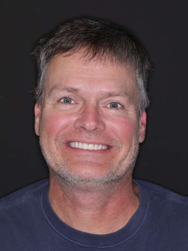 patient smiling after smile makeover
