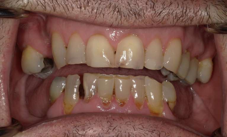 Before All-on-X Implant-Supported Dentures in Evansville, IN