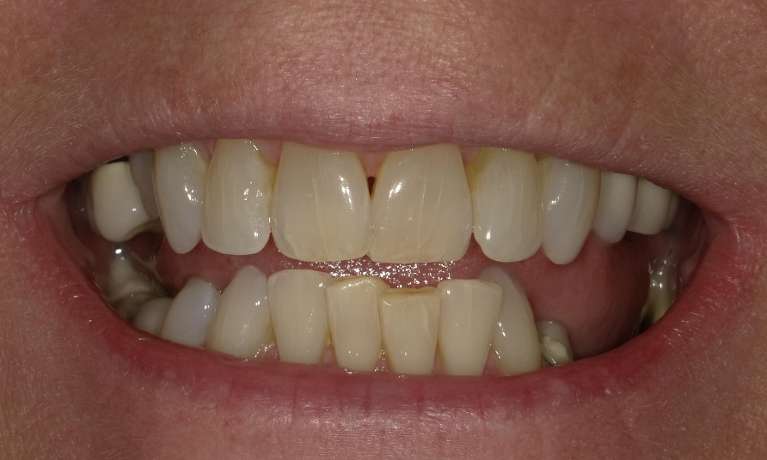 crooked and discolored teeth