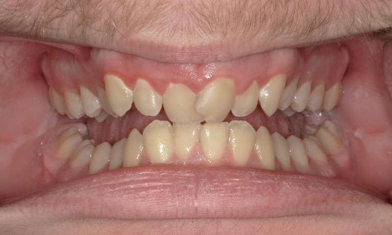crooked front teeth