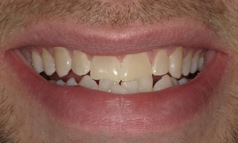 crowded bottom teeth