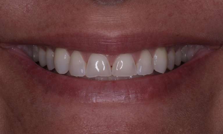 worn top teeth