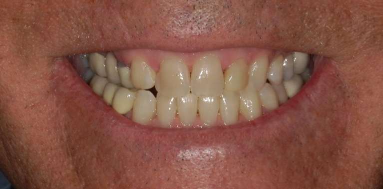 stained teeth