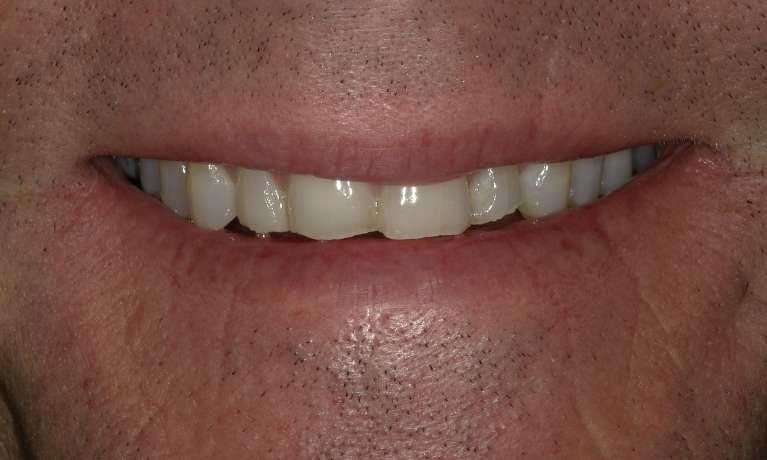 worn front teeth