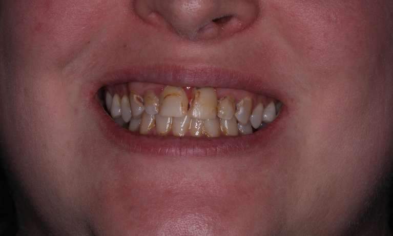 discolored and misshapen teeth