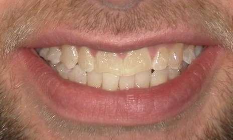 discolored and misshapen teeth