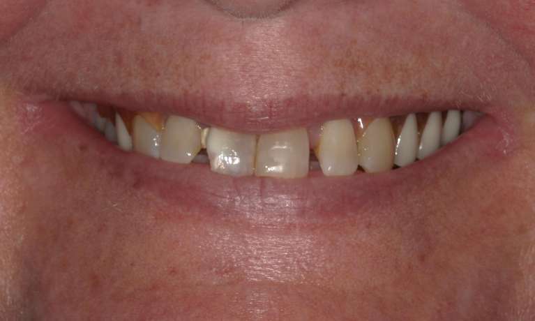 gaps between front teeth