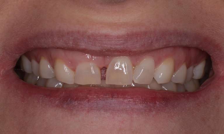 gap between two small front teeth
